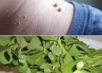 إزعاج الثآليل له علاج
