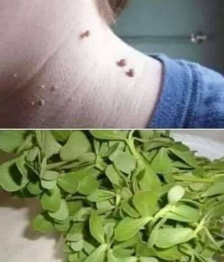 إزعاج الثآليل له علاج 1 إزعاج الثآليل له علاج