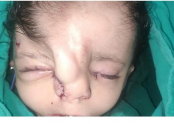 استغرقت 8 ساعات : نجاح جراحة نادرة لـ” جبهة طفلة” 3 سنوات بـ «مستشفى طنطا التعليمي»