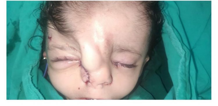 استغرقت 8 ساعات : نجاح جراحة نادرة لـ” جبهة طفلة” 3 سنوات بـ «مستشفى طنطا التعليمي» 1 استغرقت 8 ساعات : نجاح جراحة نادرة لـ” جبهة طفلة” 3 سنوات بـ «مستشفى طنطا التعليمي»
