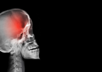 دراسة: الشفاء من السكتة الدماغية قد تؤدي إلى مرض قاتل!