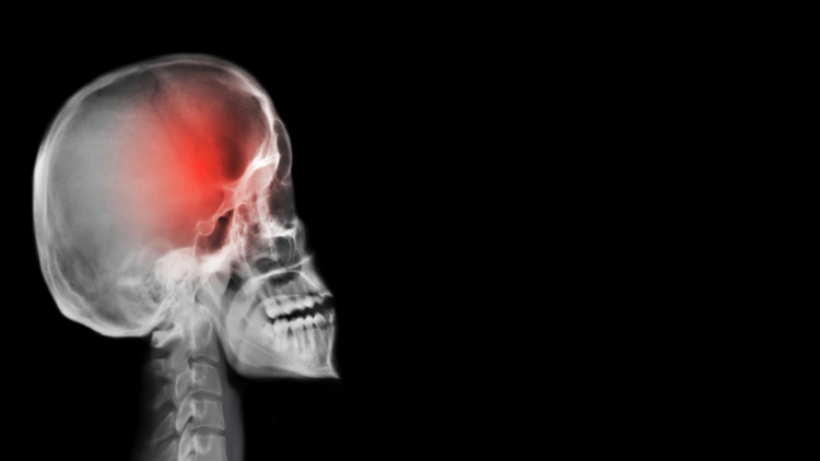 دراسة: الشفاء من السكتة الدماغية قد تؤدي إلى مرض قاتل! 1 دراسة: الشفاء من السكتة الدماغية قد تؤدي إلى مرض قاتل!