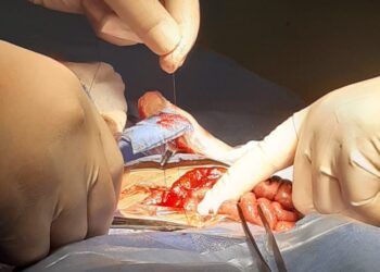 للمرة الأولى بـأجا المركزى فريق طبي ينجح في إجراء عملية انسداد معوي لطفلة عمرها ه أيام