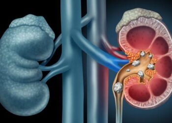إحذر … أسباب تكون الحصي على الكلى وخطورتها على الجسم