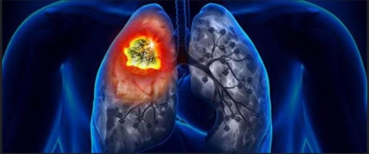 أمل جديد لمصابي سرطان الرئة ..علاج أوقف تقدم المرض 1 أمل جديد لمصابي سرطان الرئة ..علاج أوقف تقدم المرض