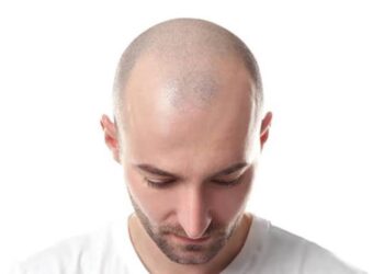 جراح تركي مختص في زراعة الشعر يحذر الرجال من مشروبات قد تسبب الصلع