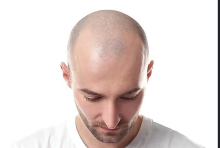 جراح تركي مختص في زراعة الشعر يحذر الرجال من مشروبات قد تسبب الصلع