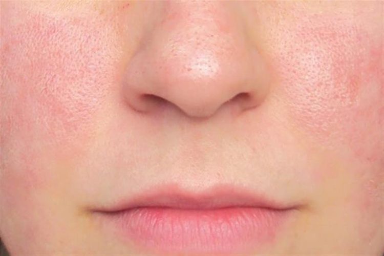 أهم أسباب وطرق علاج مسام الوجه الواسعة.. 1 أهم أسباب وطرق علاج مسام الوجه الواسعة..